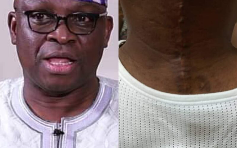 Ex-Ekiti State Governor Fayose Undergoes Surgery (Watch Video)