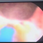 BREAKING: Hope For Men Battling Enlarged Prostate As New Laser Technology Arrives Nigeria