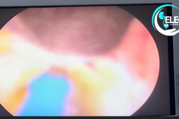 BREAKING: Hope For Men Battling Enlarged Prostate As New Laser Technology Arrives Nigeria