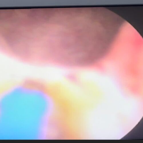 BREAKING: Hope For Men Battling Enlarged Prostate As New Laser Technology Arrives Nigeria