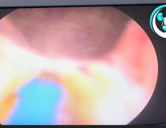 BREAKING: Hope For Men Battling Enlarged Prostate As New Laser Technology Arrives Nigeria